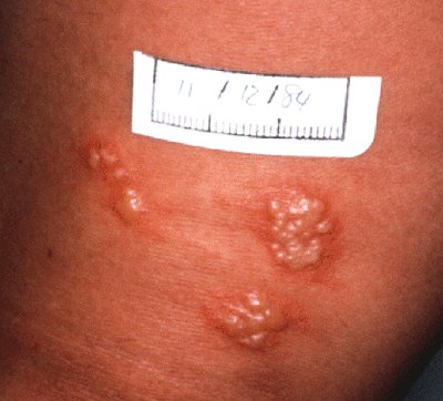 Herpes simplex, caused by Herpesvirus hominis, is a viral infection of 