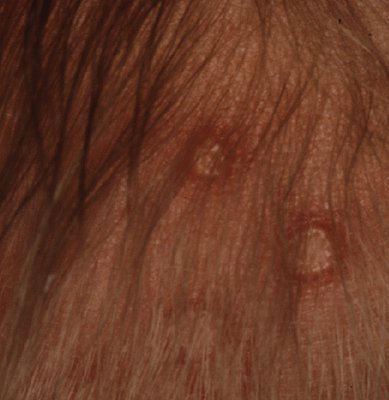 herpes Image 3