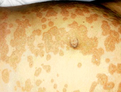 herpes Image 4