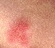 herpes Image-2